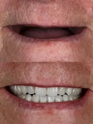 prosthodontics chesterfield denture specialists clinical dental technician chesterield dental laboratory chesterfield false teeth natural smile