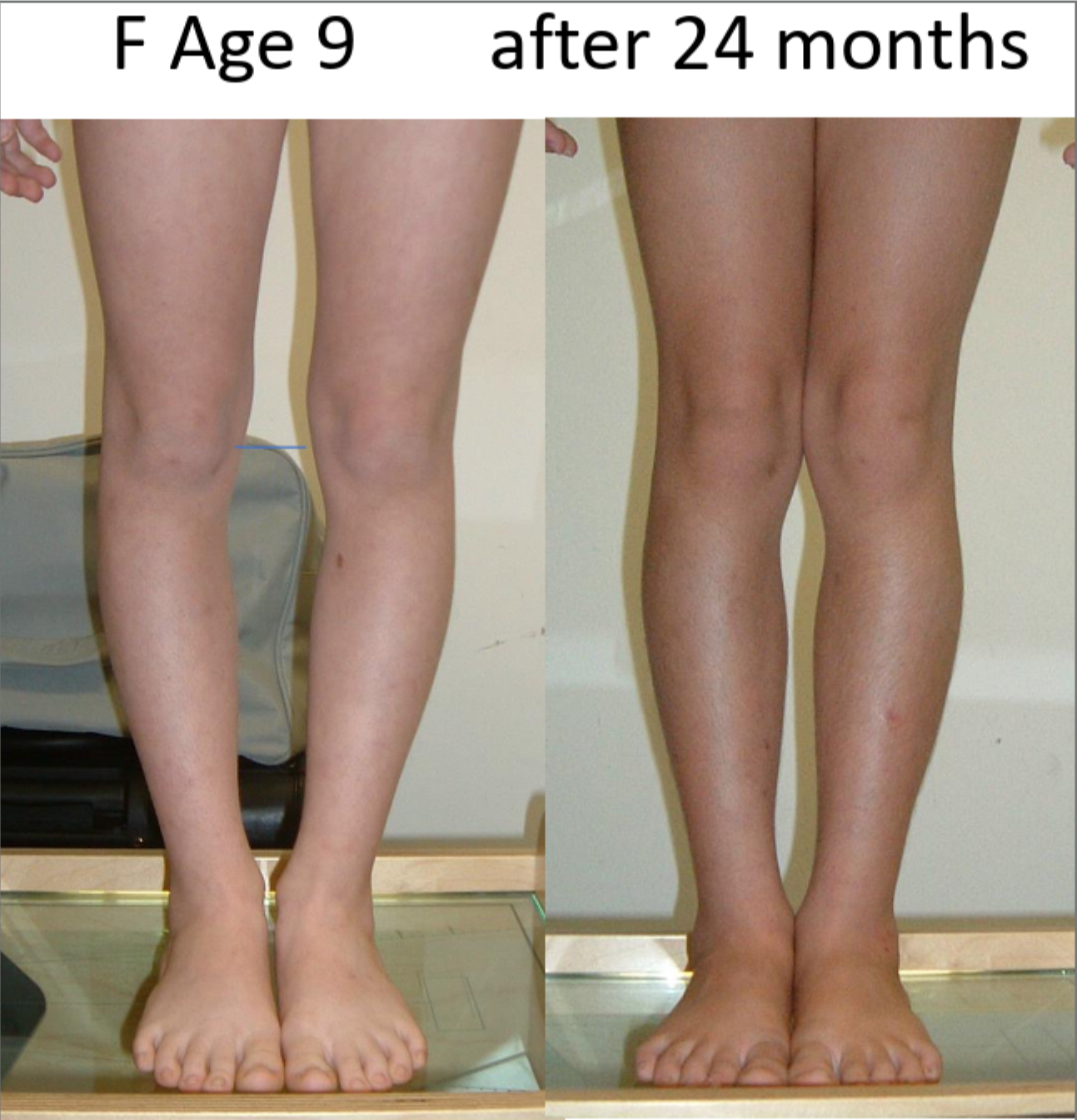 Side-by-side comparison of female legs, labeled 'Age 9' on the left and 'after 24 months' on the right, showing skin and size differences.