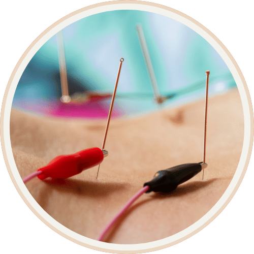 Electroacupuncture needles with red and black stimulation clips inserted in patient skin during treatment at Current Wellness