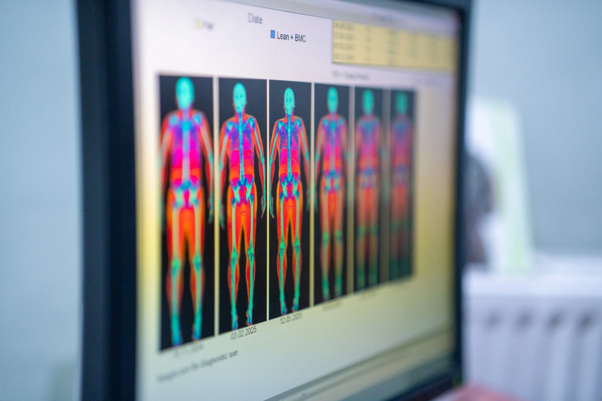 A man lying on his back on a DEXA scanner, smiling and looking up at the ceiling, with a plain wall background.