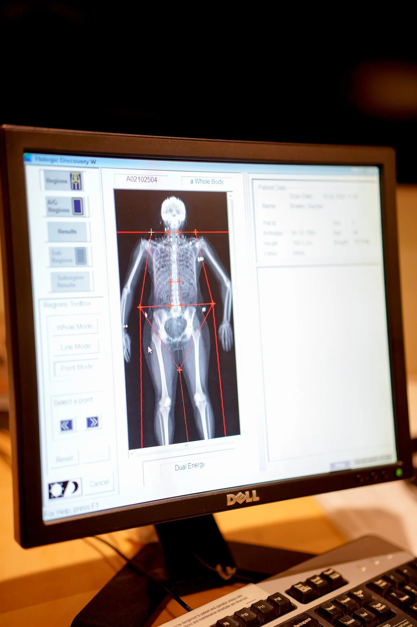 Computer monitor displaying a full body DEXA scan with red measurement lines