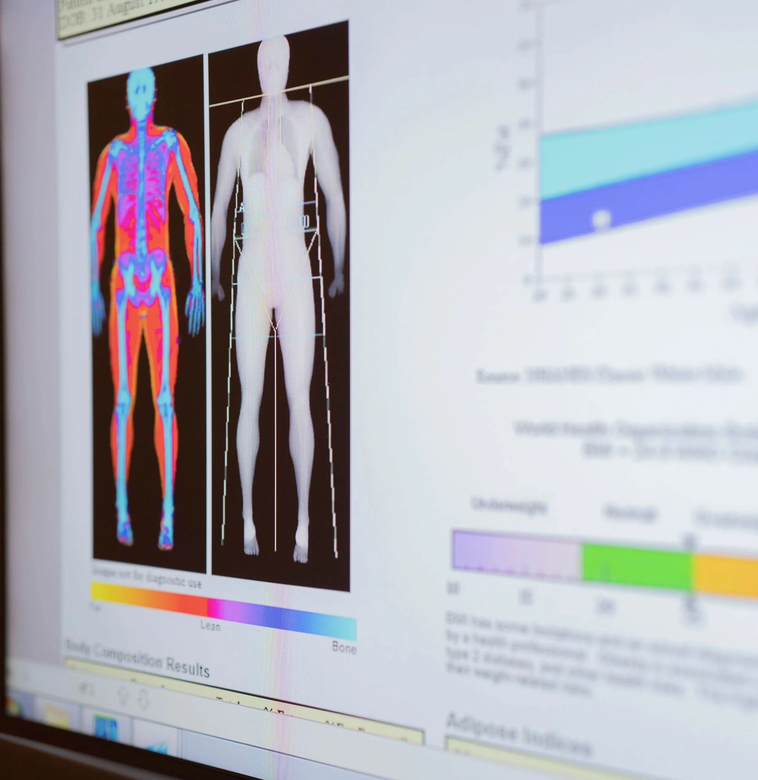 A man lying on his back on a DEXA scanner, smiling and looking up at the ceiling, with a plain wall background.