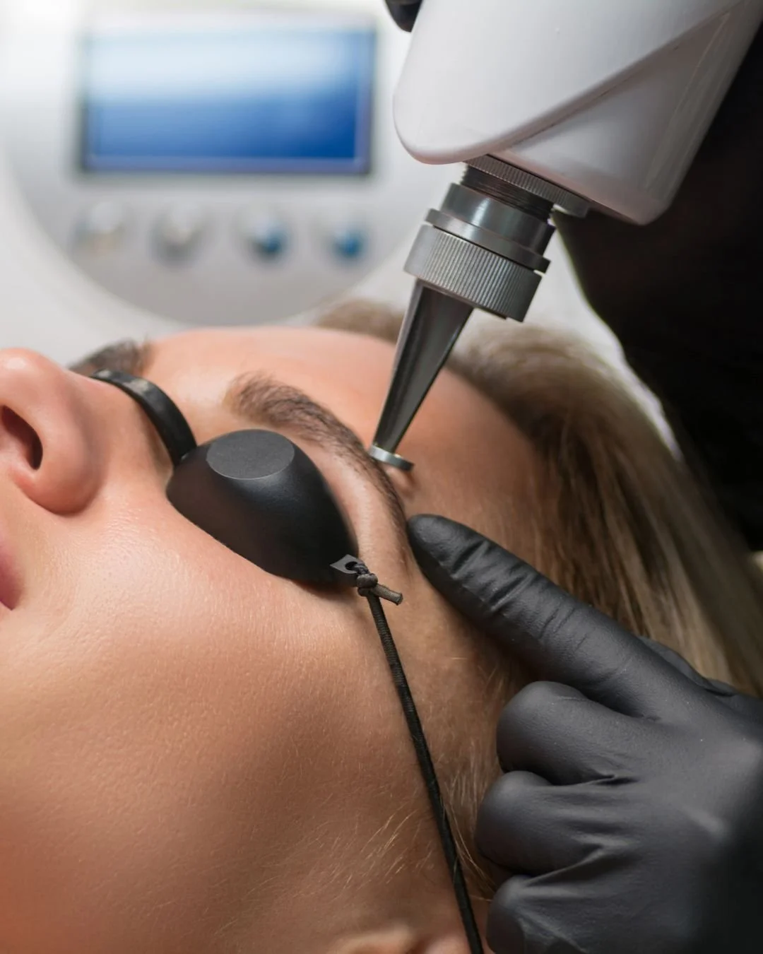 A person receiving a laser treatment on the face, lying down with eye protection, while a technician handles a medical device.