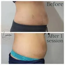 Side-by-side comparison of a person's abdomen labeled 'Before' showing loose skin and stretch marks, and 'After 1 session' showing a smoother, tighter appearance.