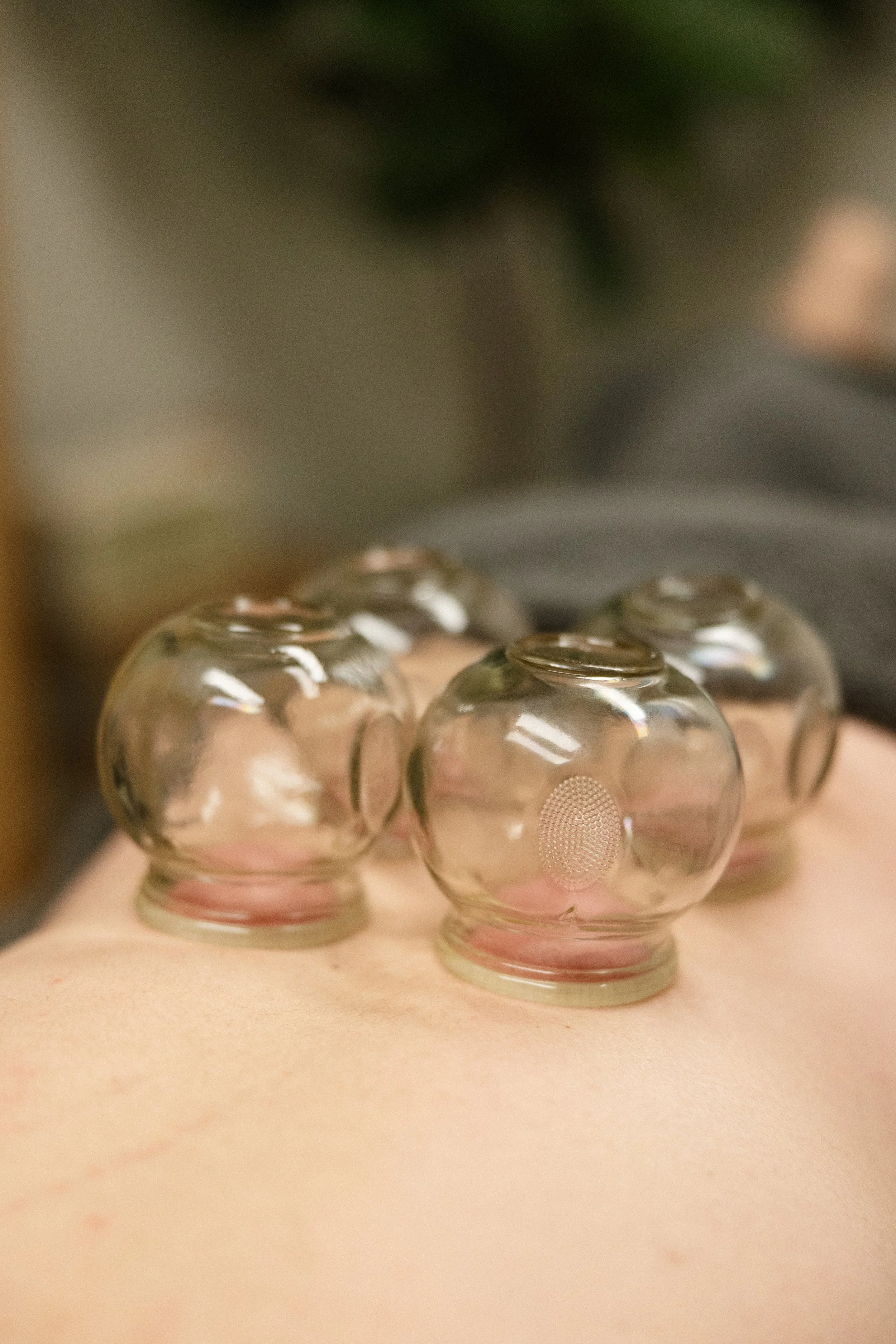 Four glass cupping therapy cups placed on a person's back.