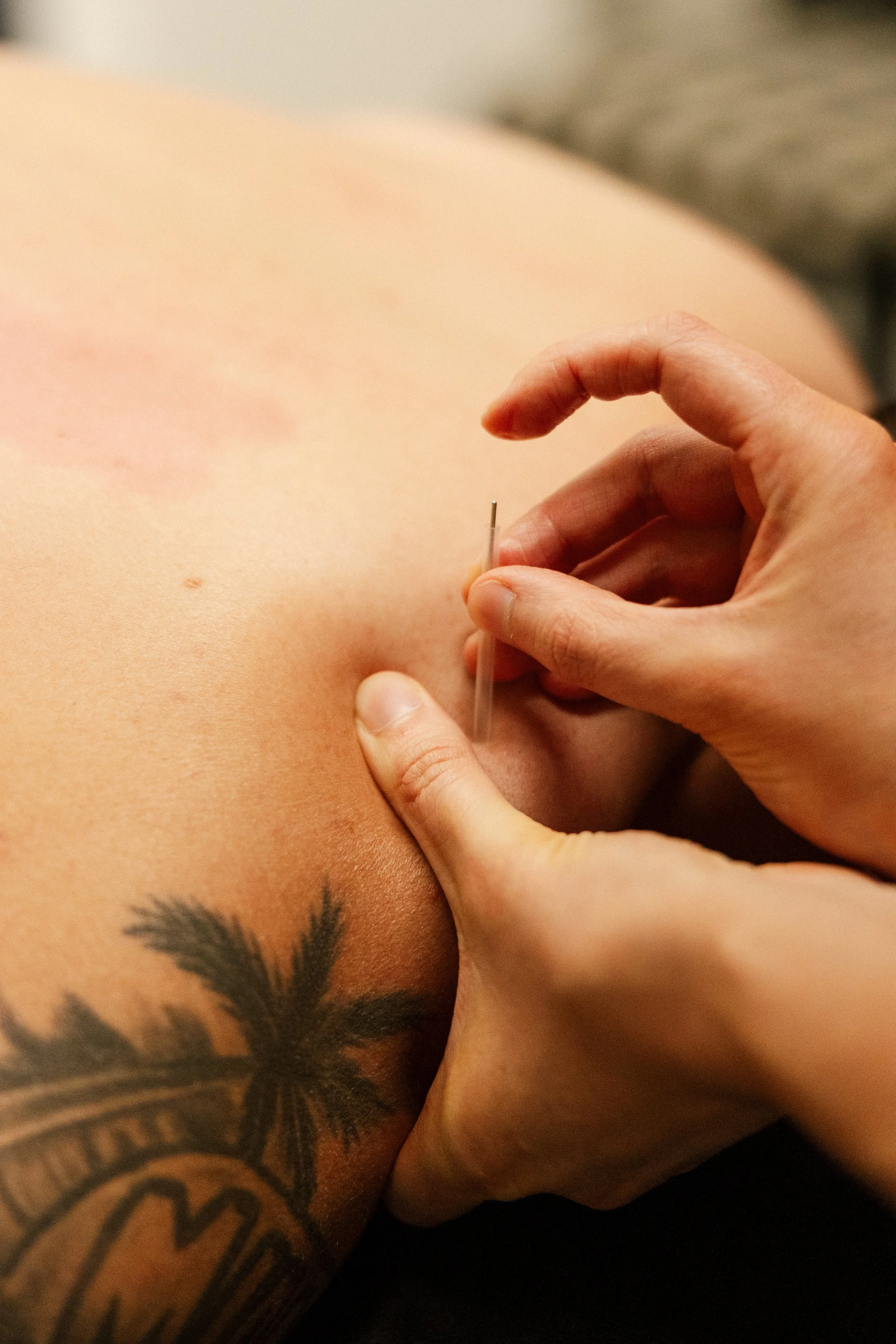 Person receiving an acupuncture treatment on their back, with a palm tree tattoo visible on their side.