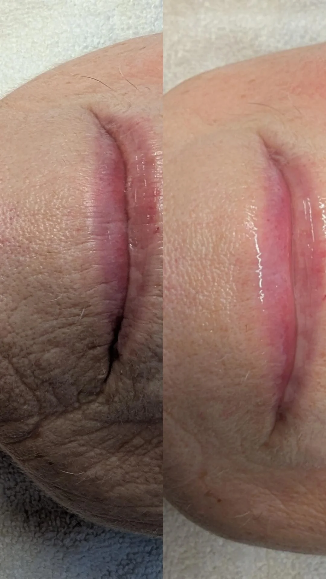 Before after images showing huge redutcion in wrinkles around lips