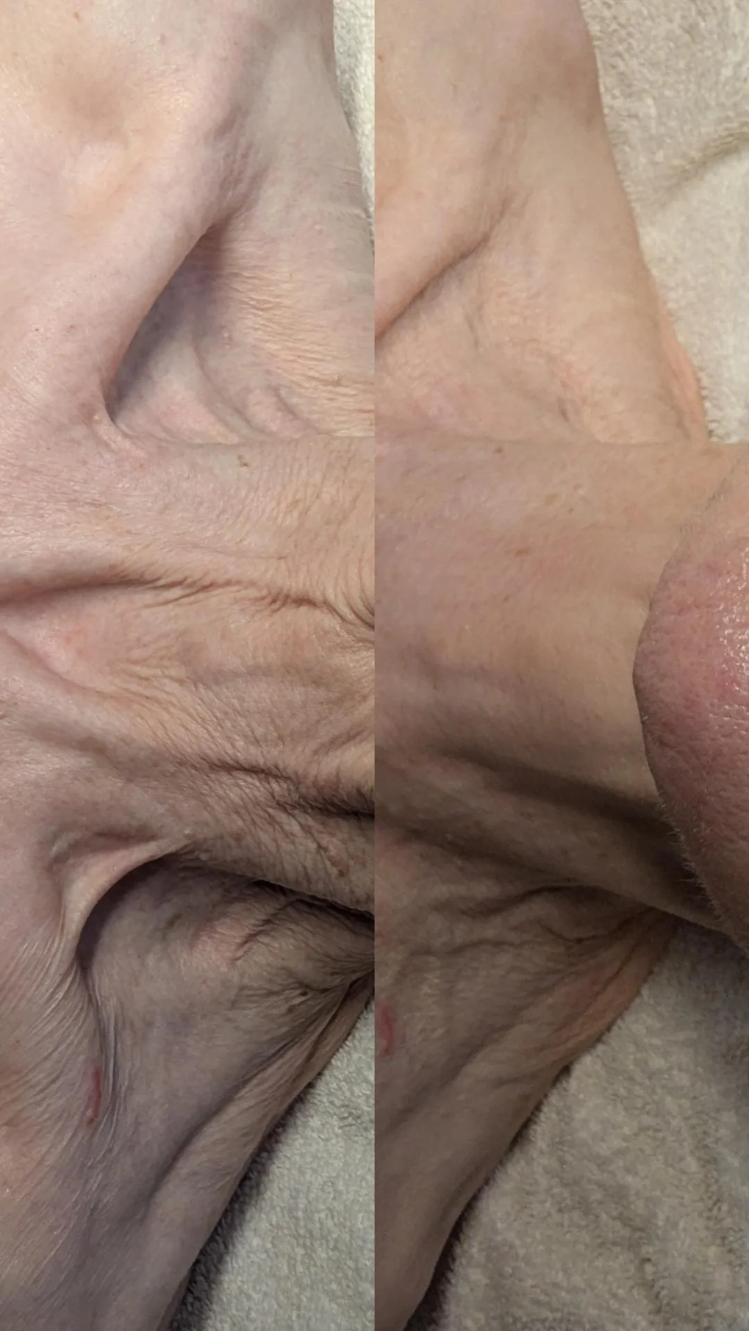 Two images showing remarkable reduction in wrinkles on a neck.