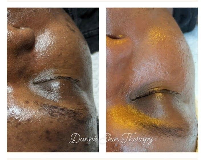 Before and after showing a great reduction in pigmentation and dark scars