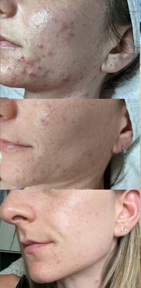 Three images showing transformation from acne covered skin to clear, smooth skin.