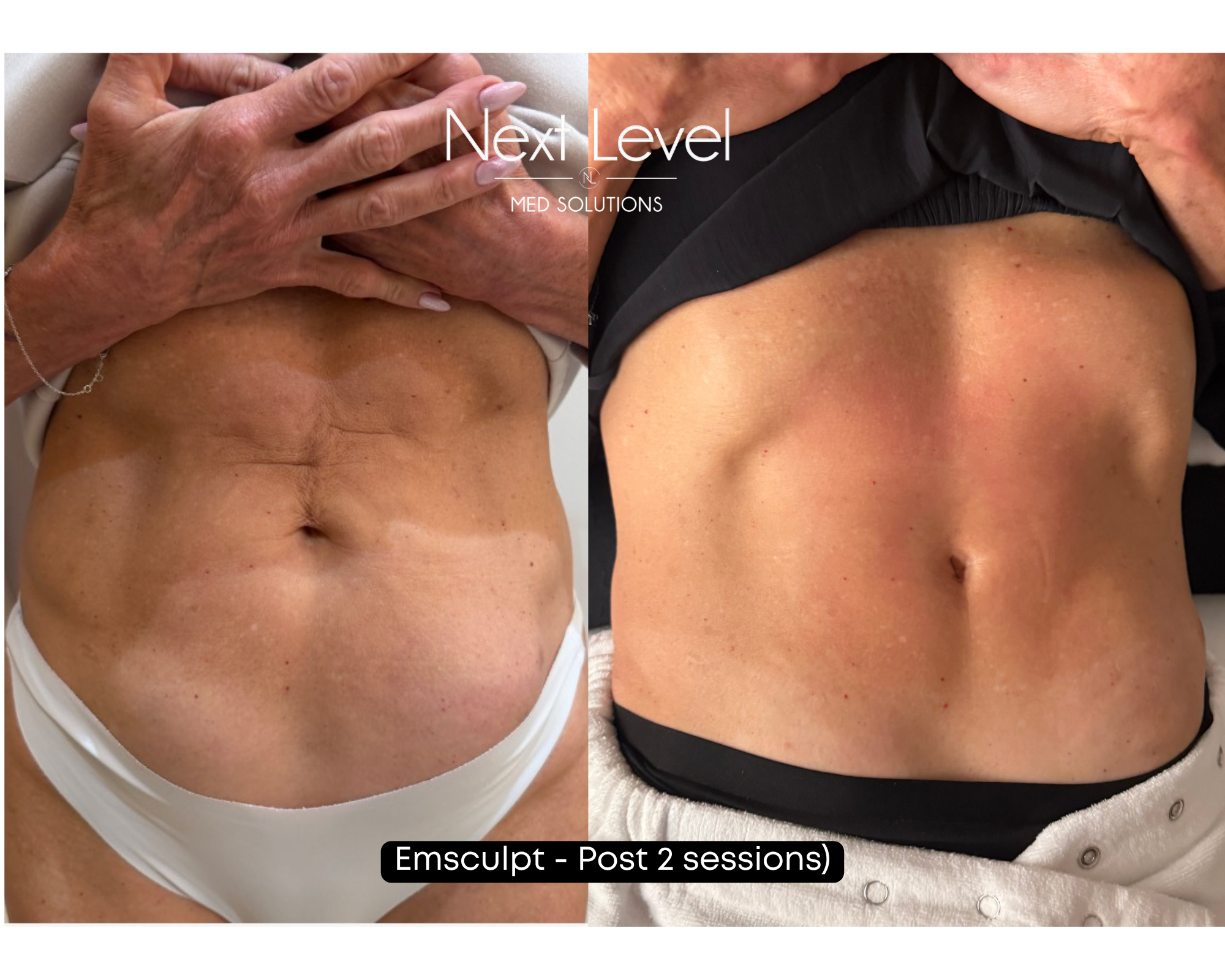 Emsculpt Post 2 Session.png