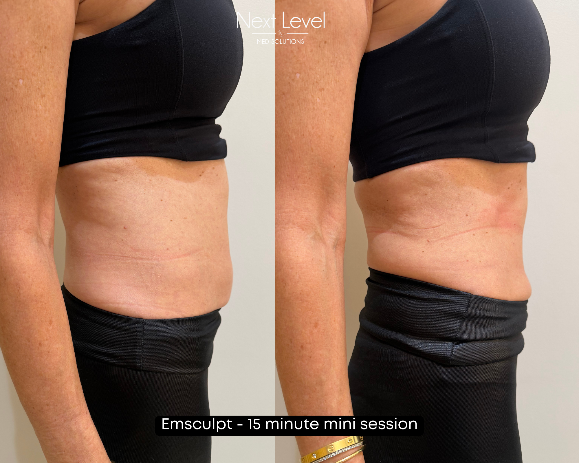 Emsculpt Mini Session 2.png