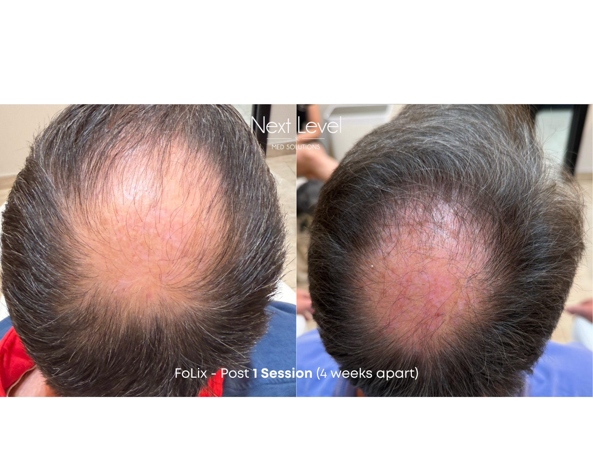 FoLix Before and After.png