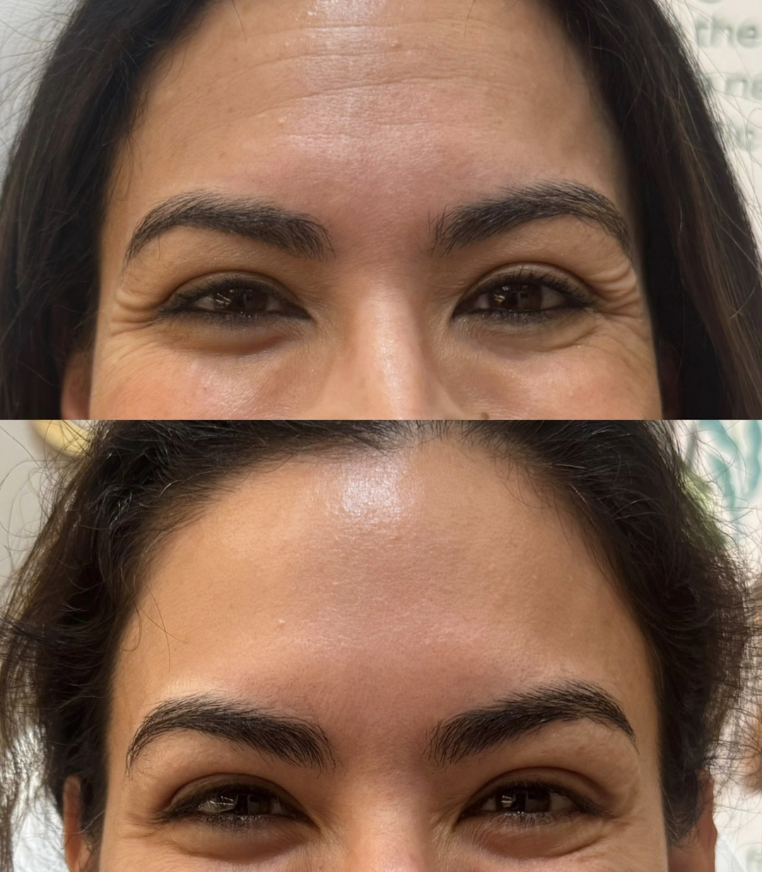 Before and After Botox Treatment