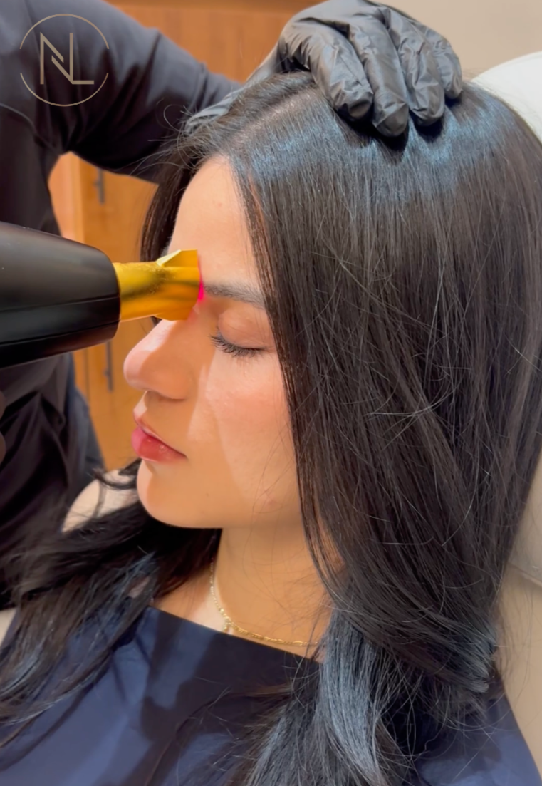 A woman is receiving a eyebrow hair follicle restoration laser treatment, with a laser technician using a laser device while wearing black gloves.