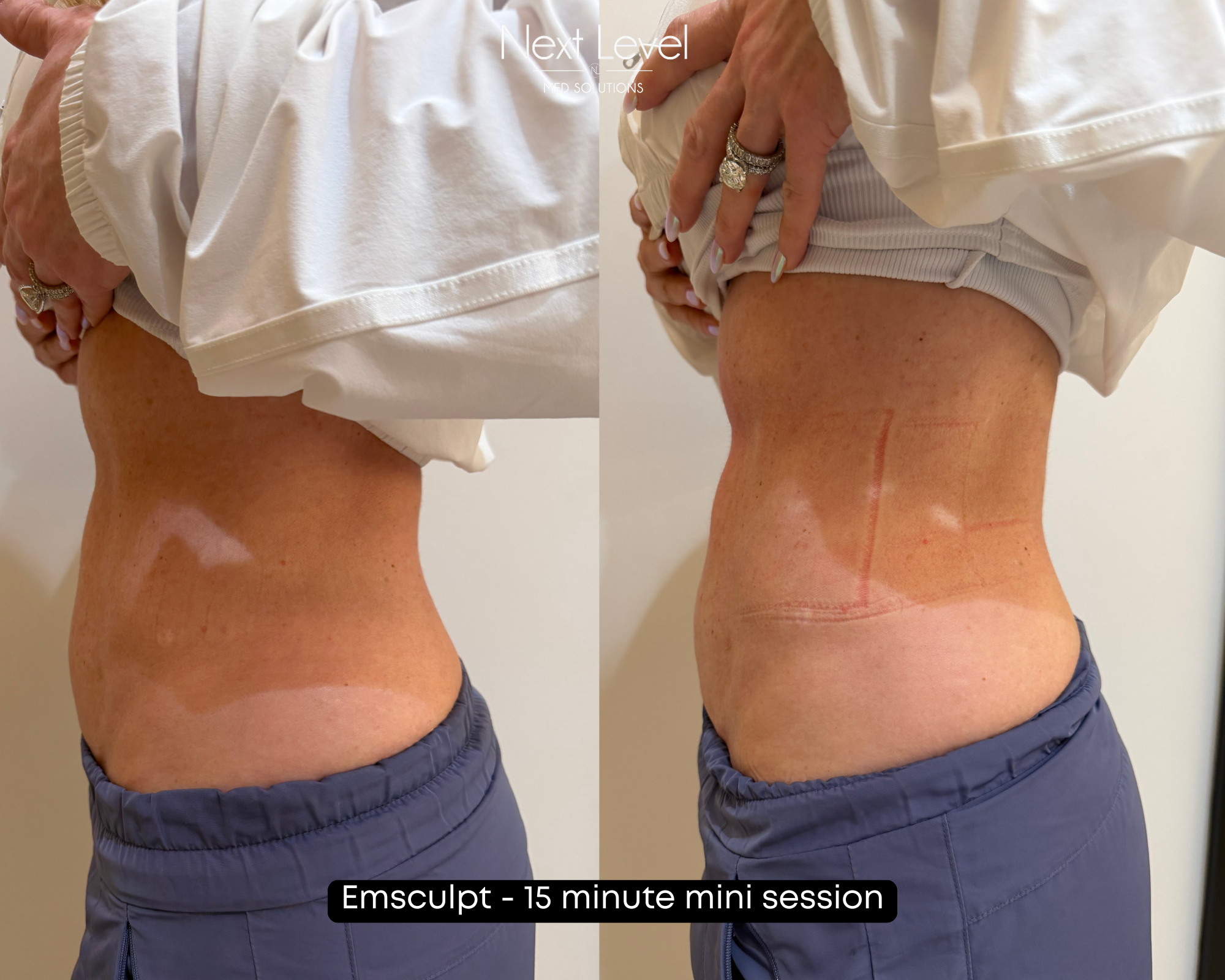 Emsculpt Mini Session.png