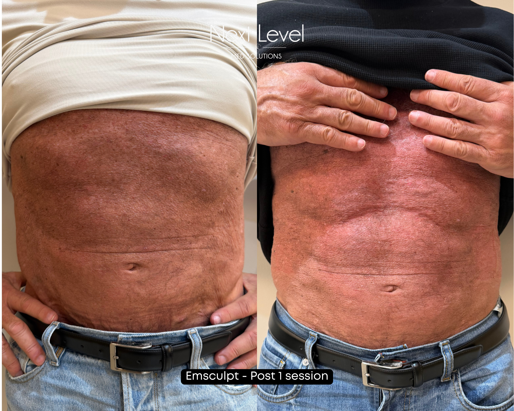 Emsculpt 1 Session.png