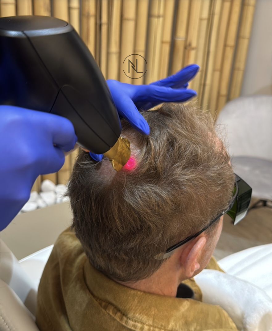 A person undergoing laser hair restoration treatment on their scalp, wearing protective glasses and blue gloves, with a FDA-cleared laser device emitting light.