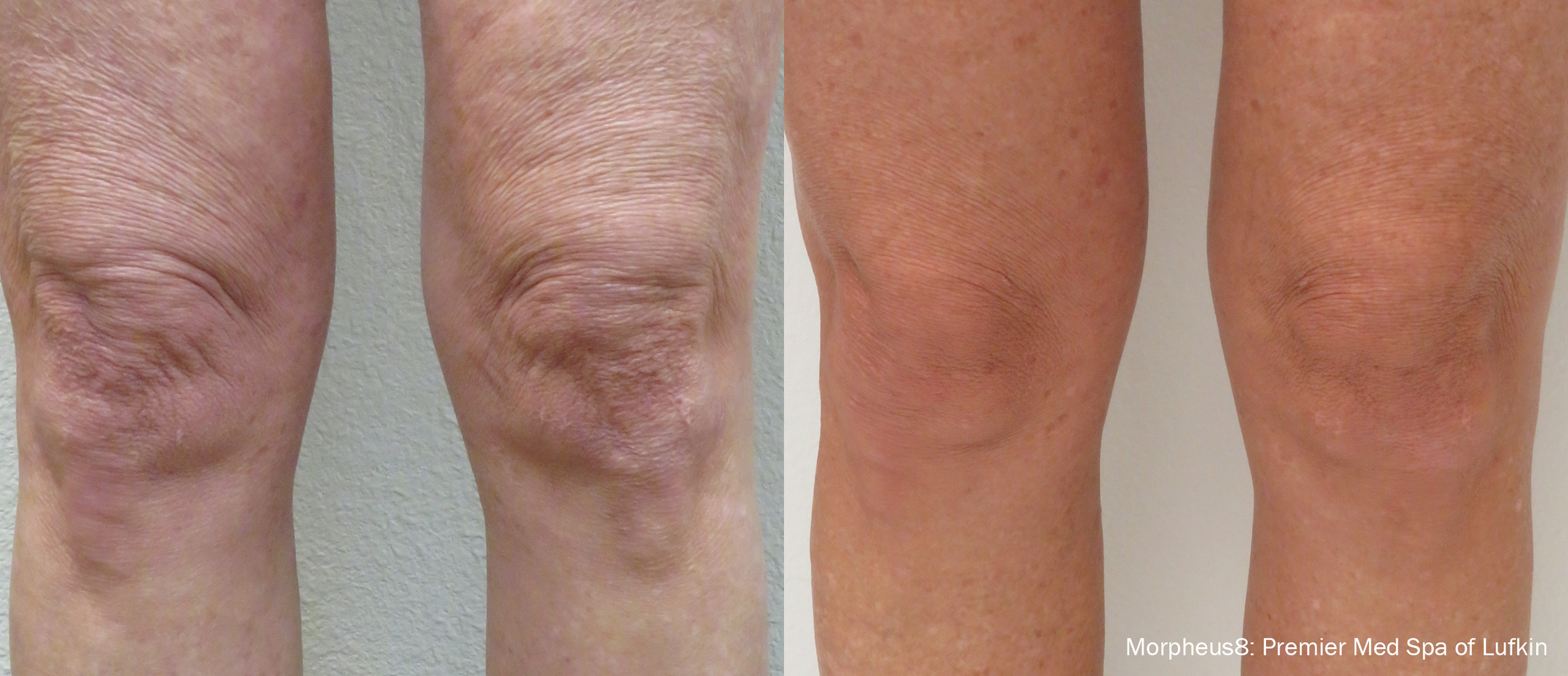 morpheus8-before-after-premier-med-spa-of-lufkin-preview-1.png