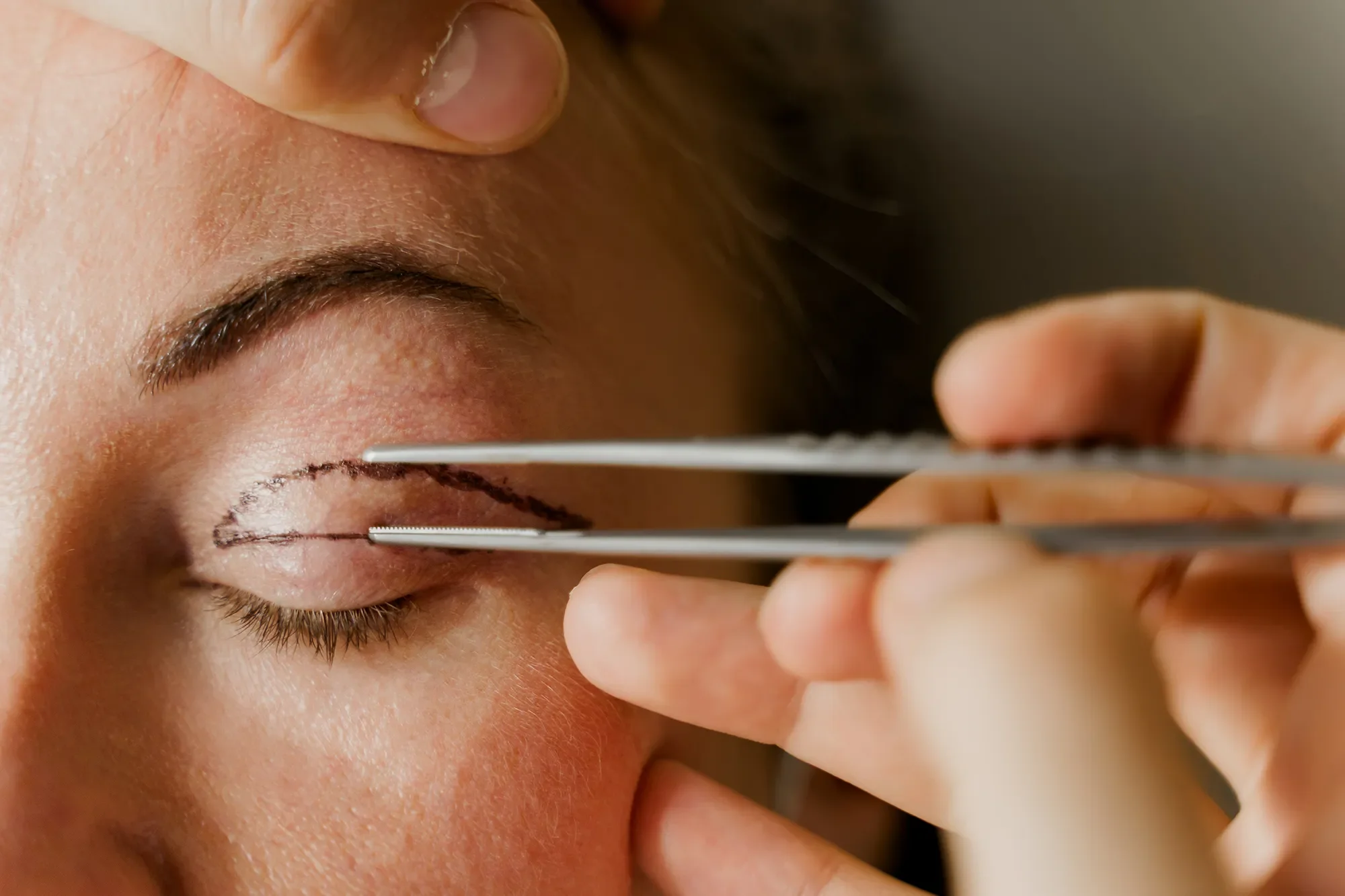 plastic surgeon marking and measuring for eye lid surgery