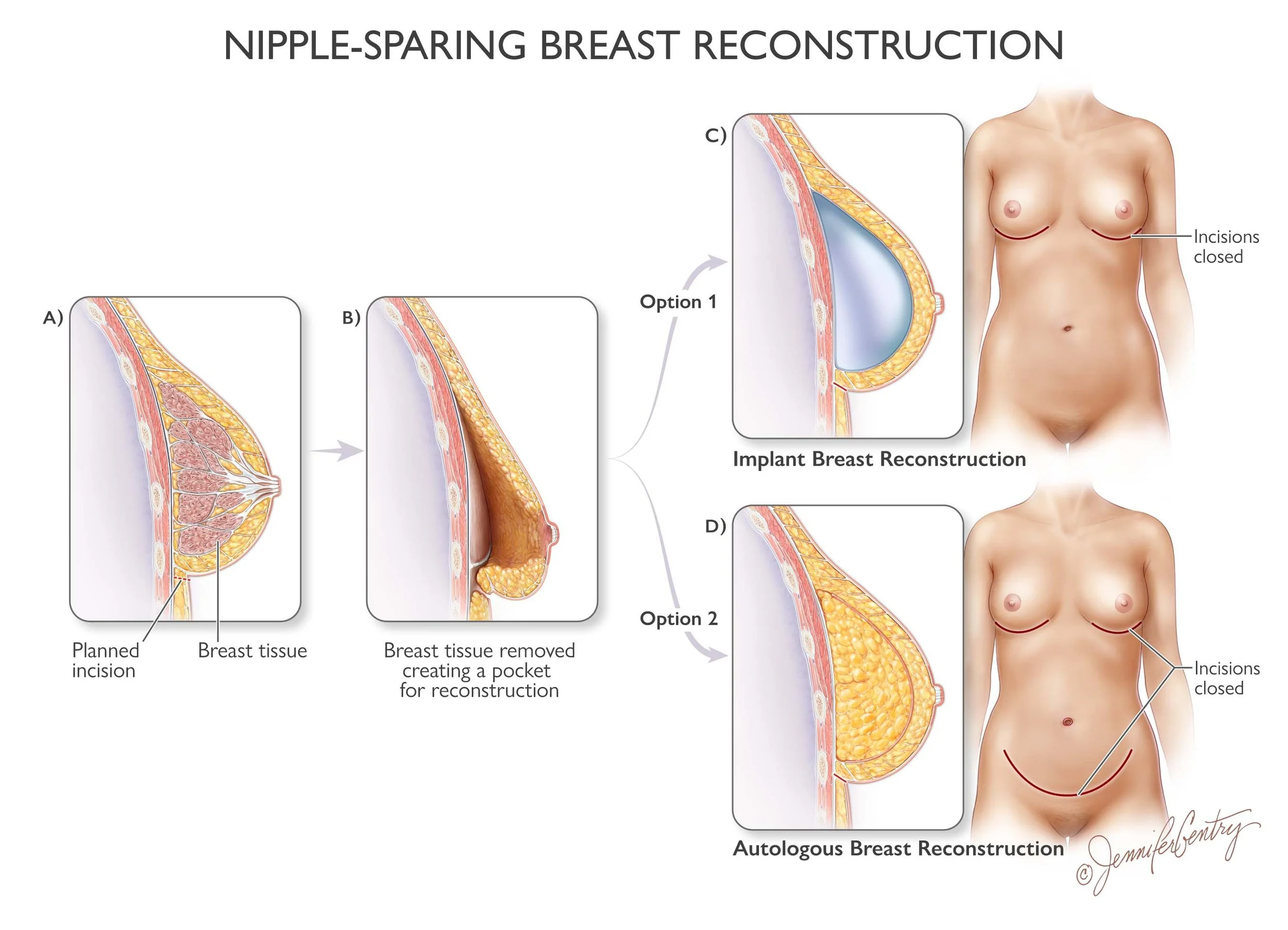 Diagram showing the steps of nipple-sparing breast reconstruction. Part A depicts a breast with a planned incision. Part B shows breast tissue removed, creating a pocket. Options 1 and 2 illustrate implant and autologous reconstruction methods, with images of a woman showing incisions closed after each procedure.