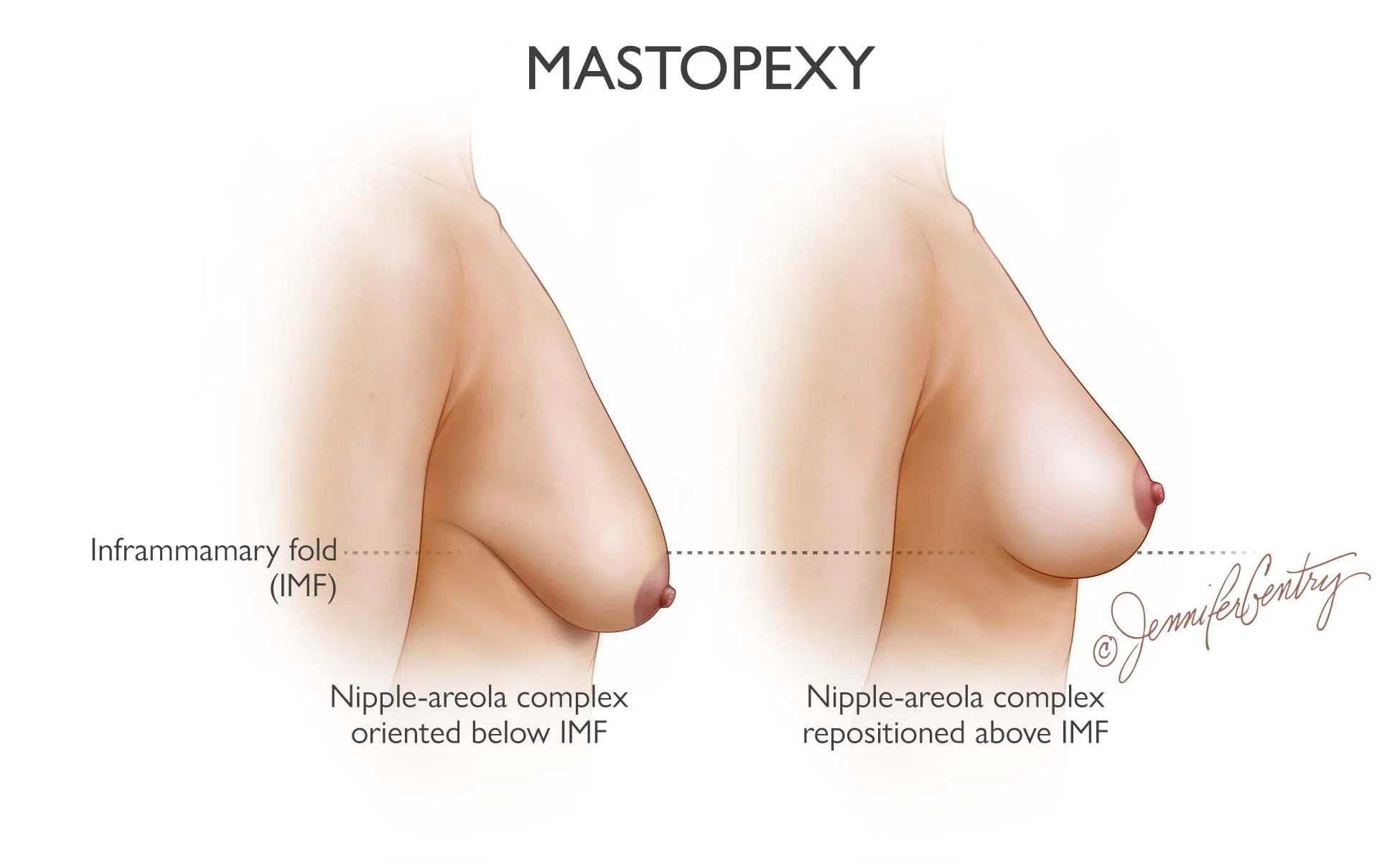 Comparison of breasts before and after mastopexy surgery, showing nipple repositioned above Inframammary fold with annotations of nipple-areola complex orientation.