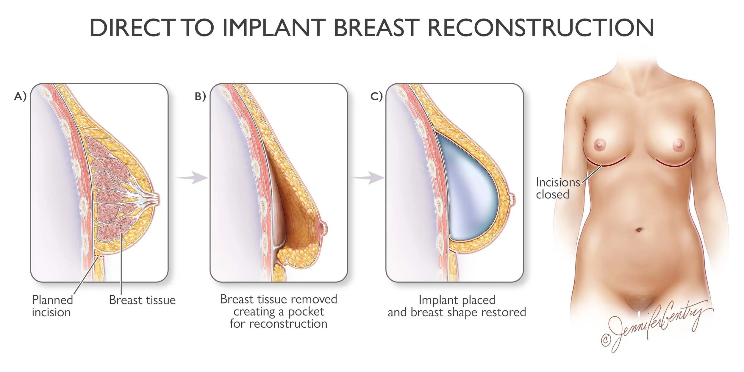 Diagram showing three stages of direct-to-implant breast reconstruction with labels: 'planned incision,' 'breast tissue,' and 'implant placed and breast shape restored.' An illustration of a woman's upper torso with incisions marked on breasts.