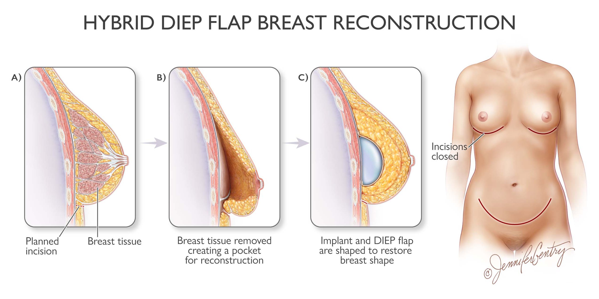 Diagram showing the steps of hybrid DIEP flap breast reconstruction, including planned incision, breast tissue removal, implantation with shaped DIEP flap, and a silhouette of a woman with incisions marked on her breasts.