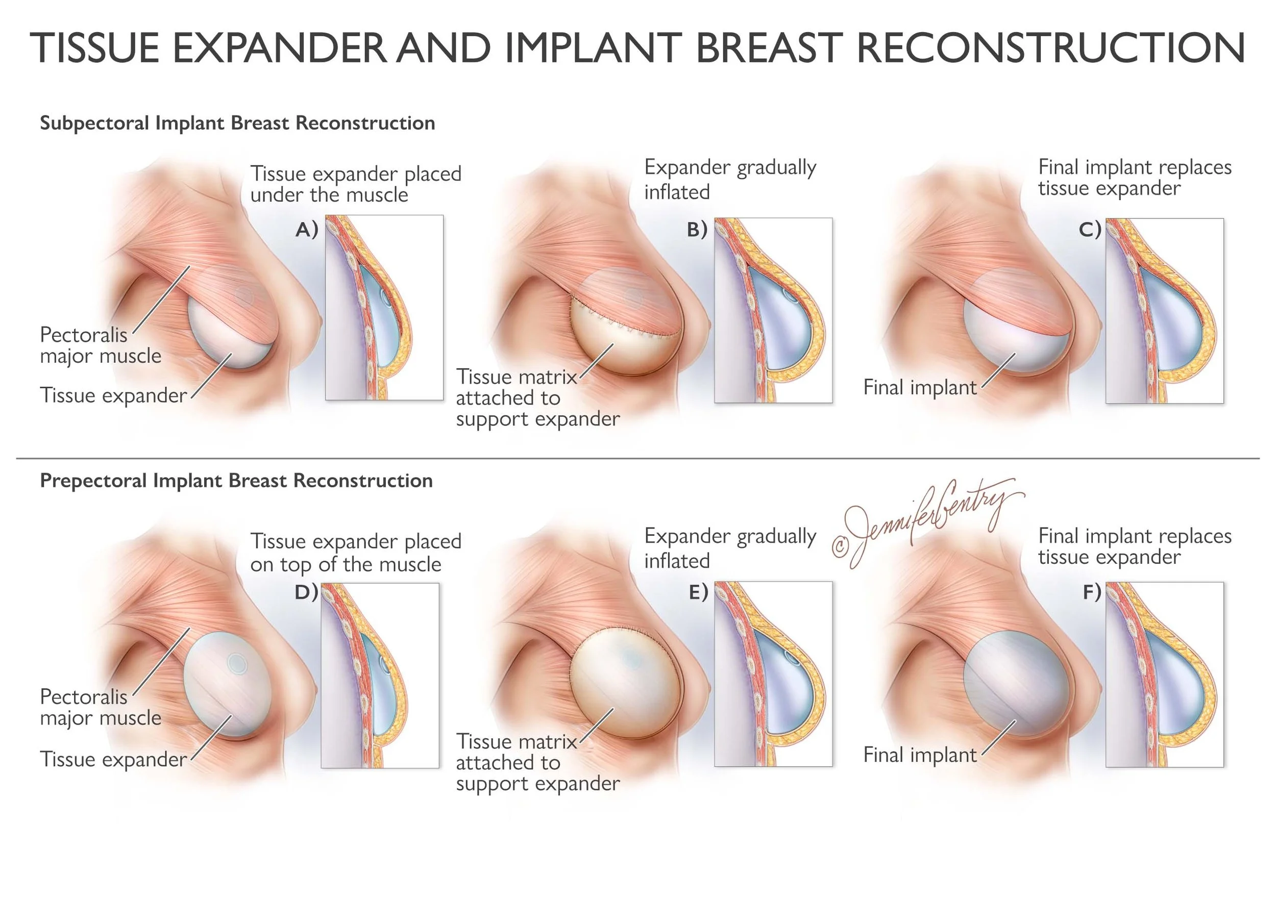 Diagram showing tissue expander and implant breast reconstruction procedures, including subpectoral and prepectoral techniques, with steps of placing tissue expanders, inflating, and replacing with final implants.
