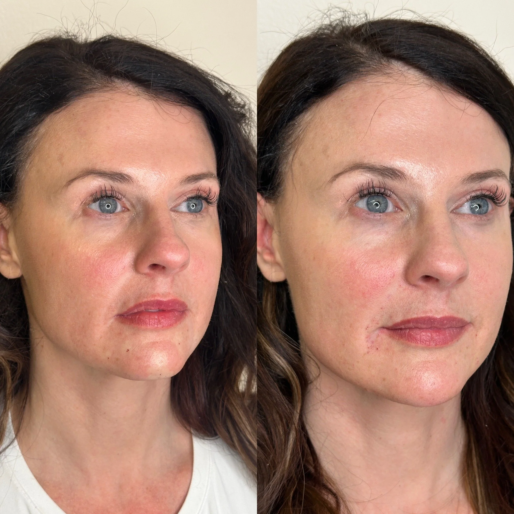 How Many Syringes Do You Really Need for Facial Balancing? (What Most Injectors Won’t Tell You)