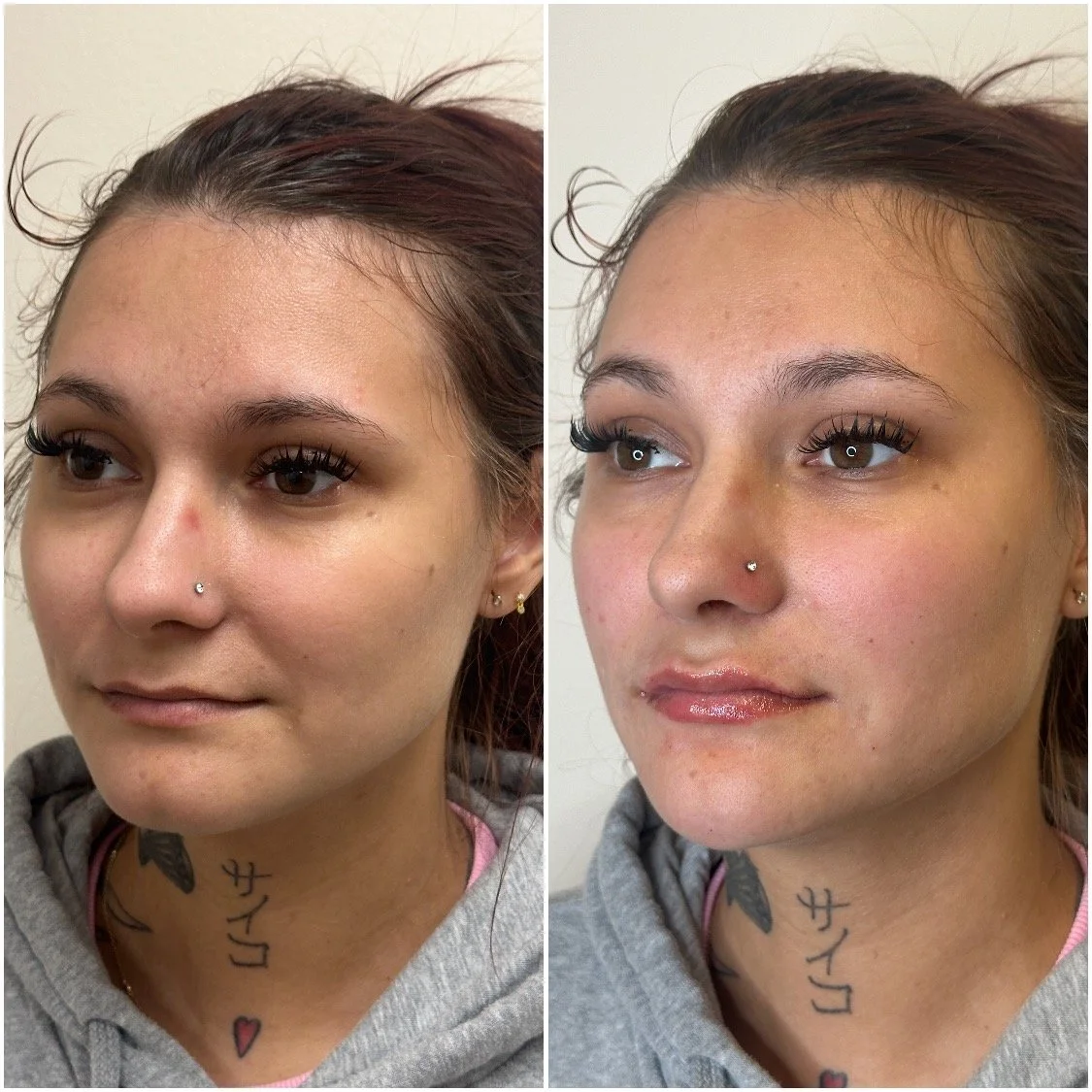 What Is Facial Balancing? (And Why Everyone Is Talking About It)