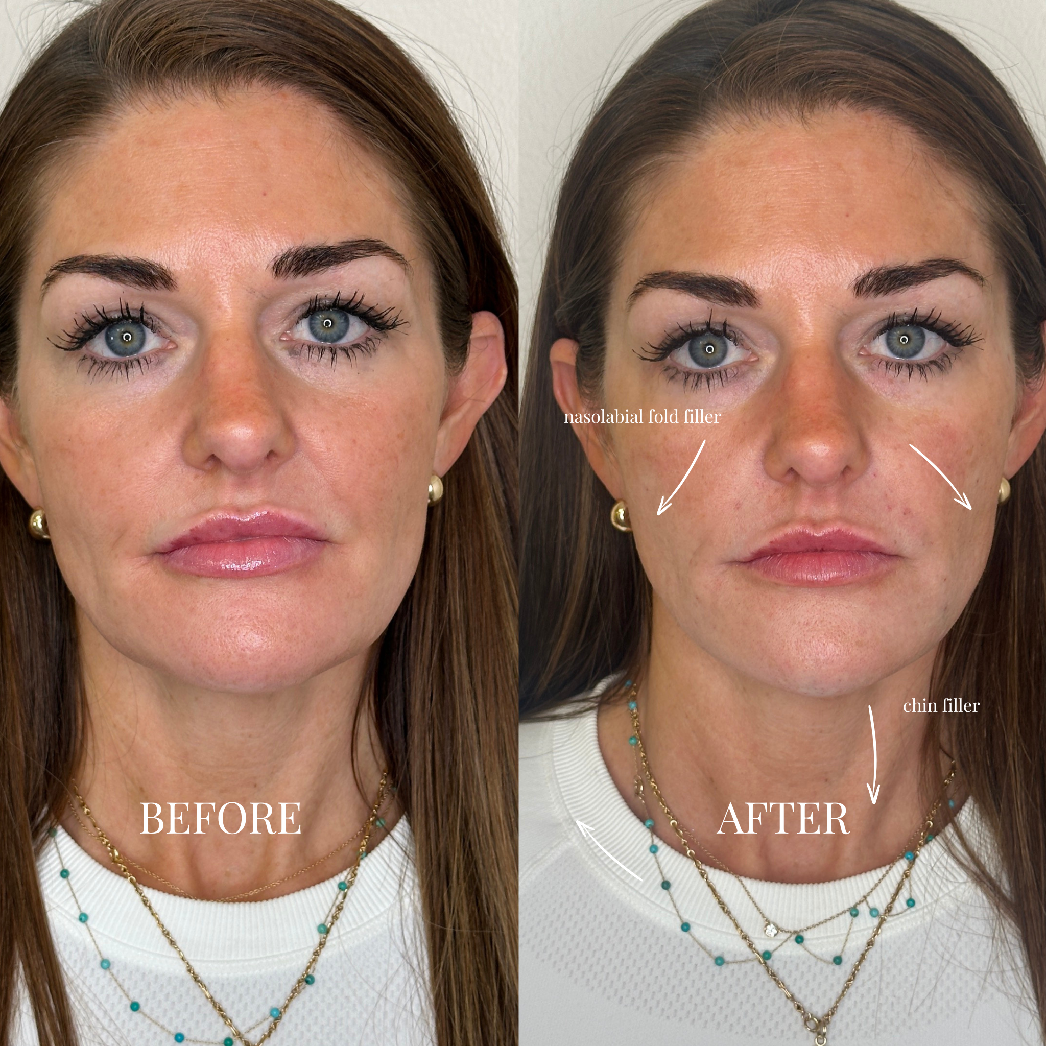 How Much Filler Do You Actually Need? (Realistic Expectations)