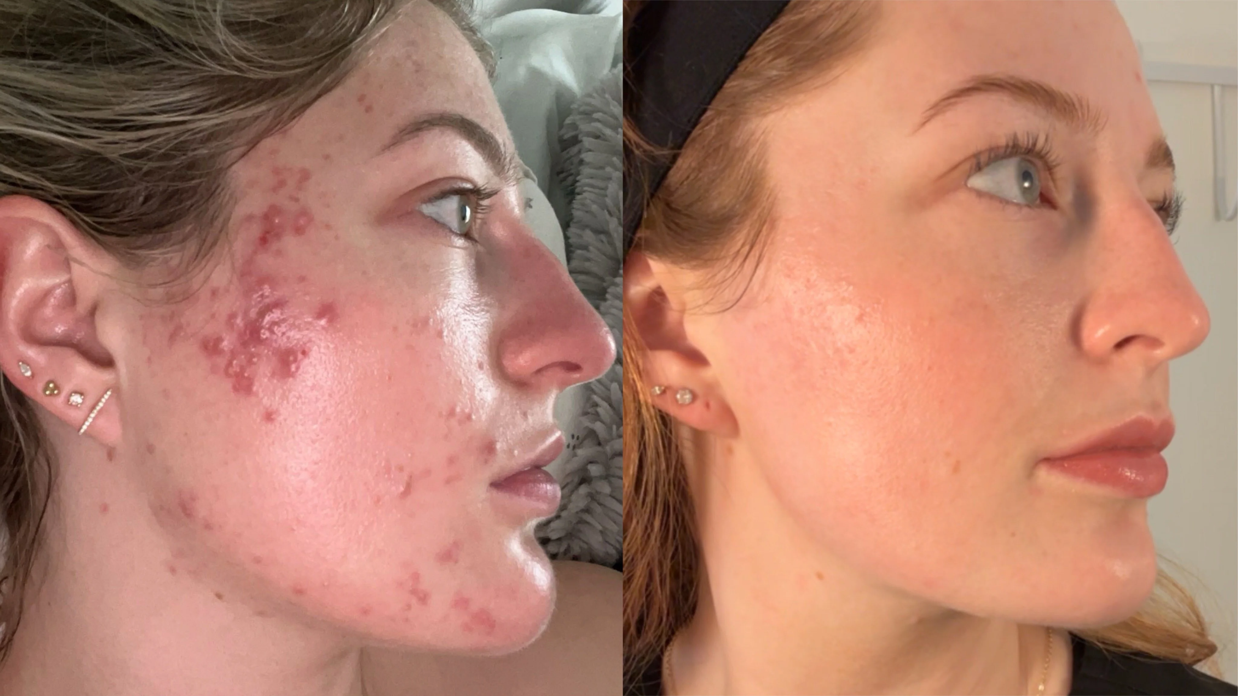 severe acne, 6 month bootcamp + maintenance