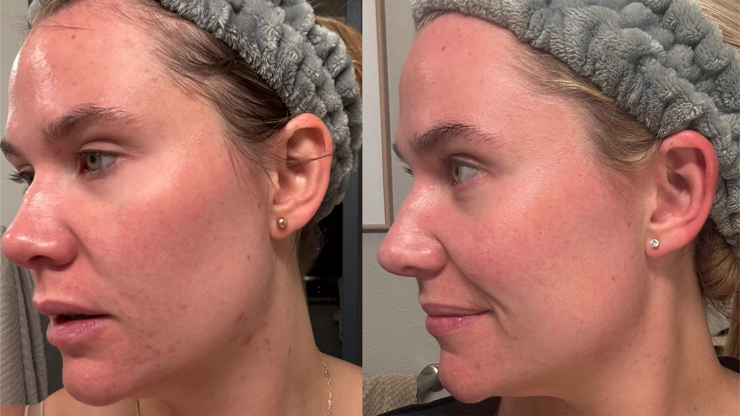 mild acne, 3 month bootcamp + maintanence
