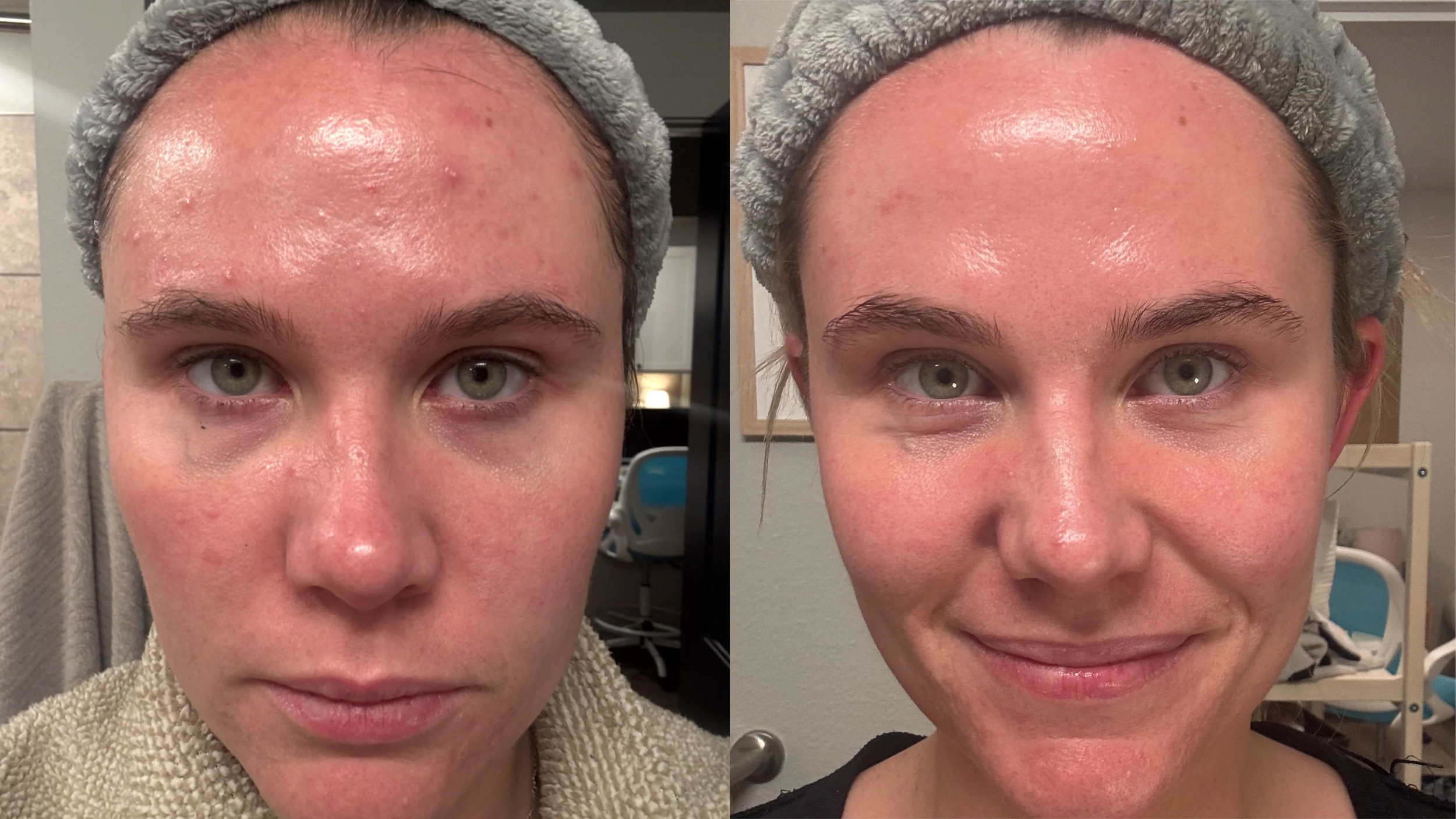 mild acne, 3 month bootcamp + maintenance 
