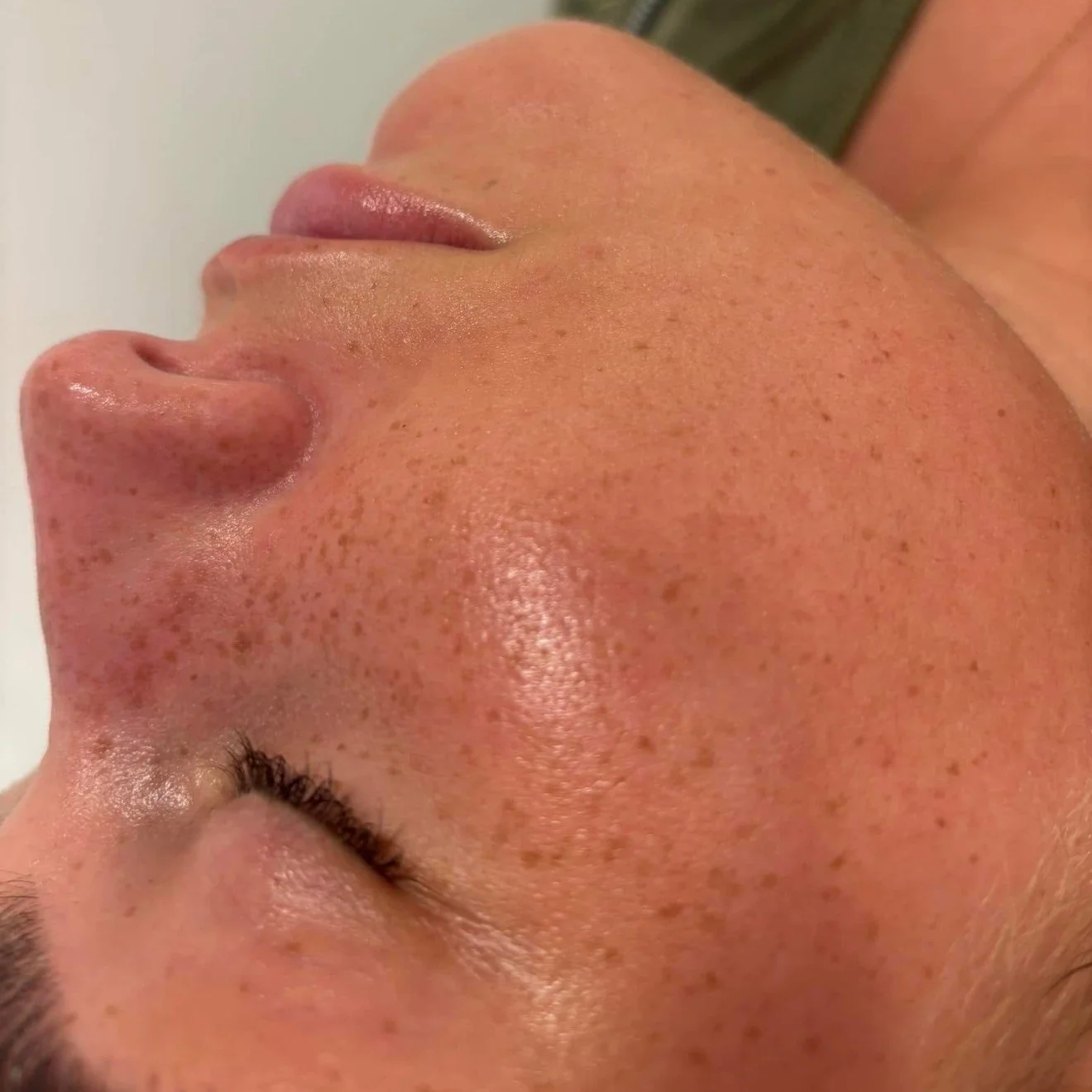 Close-up of a person's face showing closed eyes and prominent freckles, with smooth skin and natural lighting.