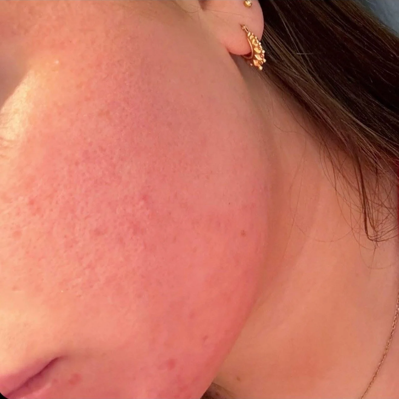 Close-up of a woman's cheek with red, irritated skin and light freckles, wearing a gold earring and a necklace.