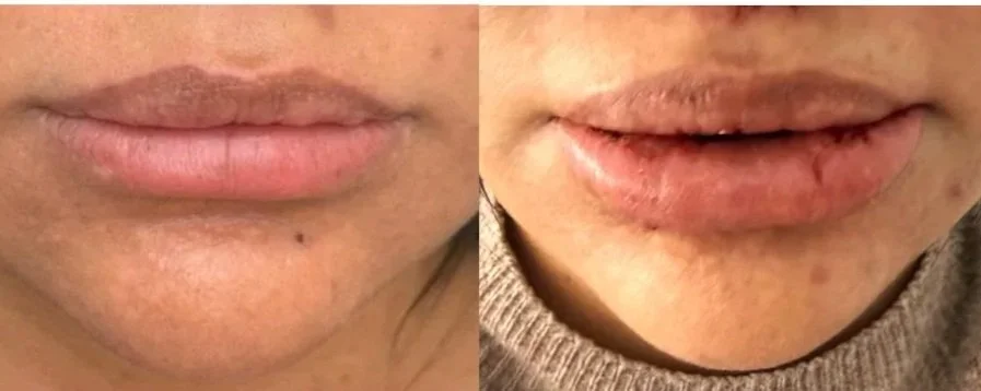 Cuando el problema no es el labio: análisis del tercio inferior en la queiloplastia compleja
