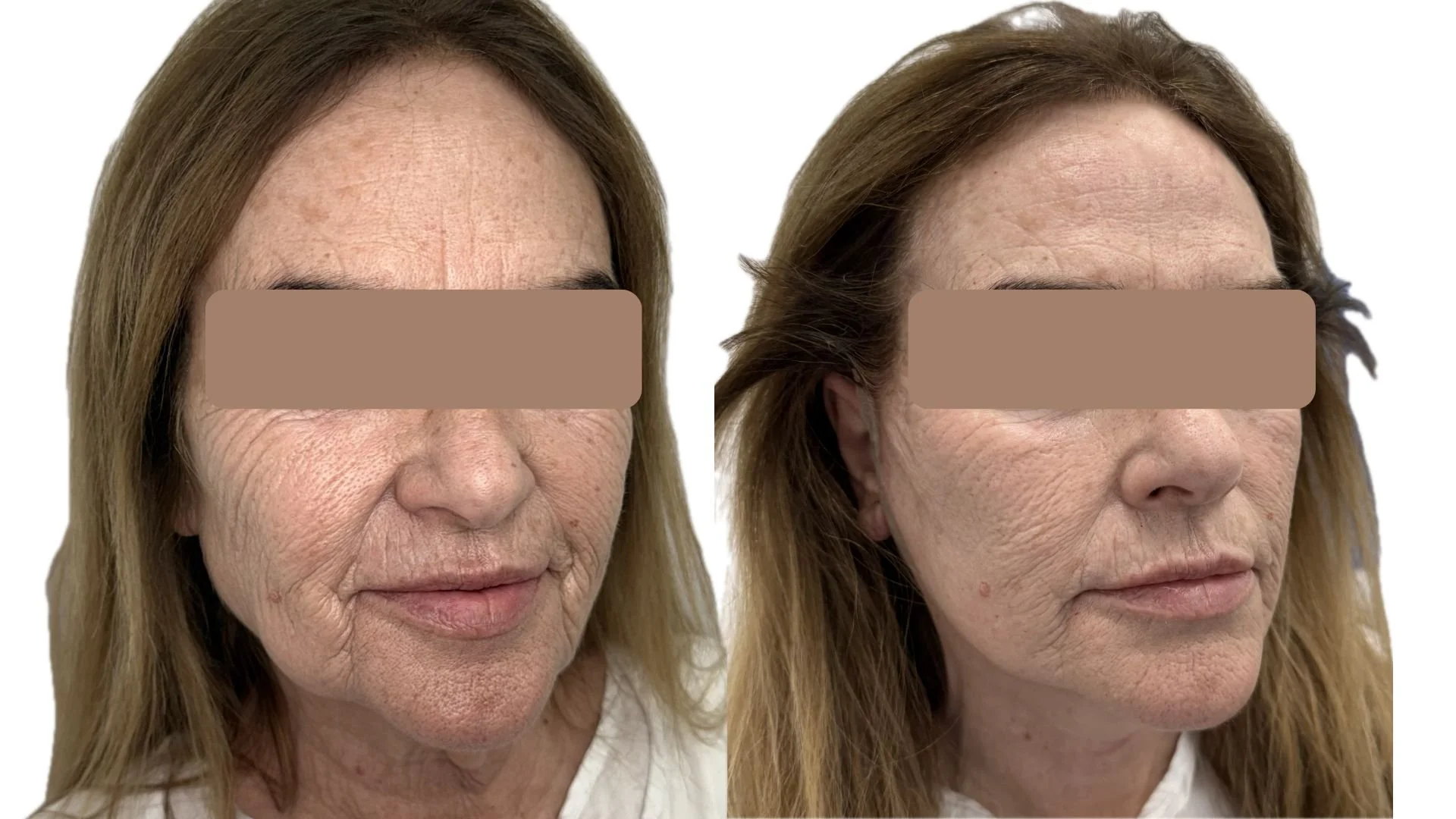 Minilifting facial: cuando la medicina estética ya ha dado todo lo que podía