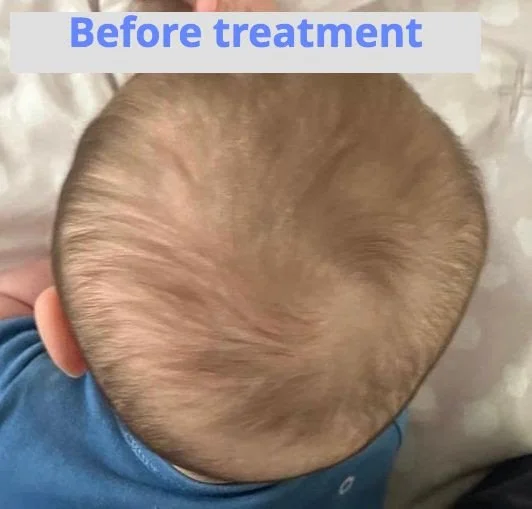 "Understanding Plagiocephaly: A Guide for Parents"