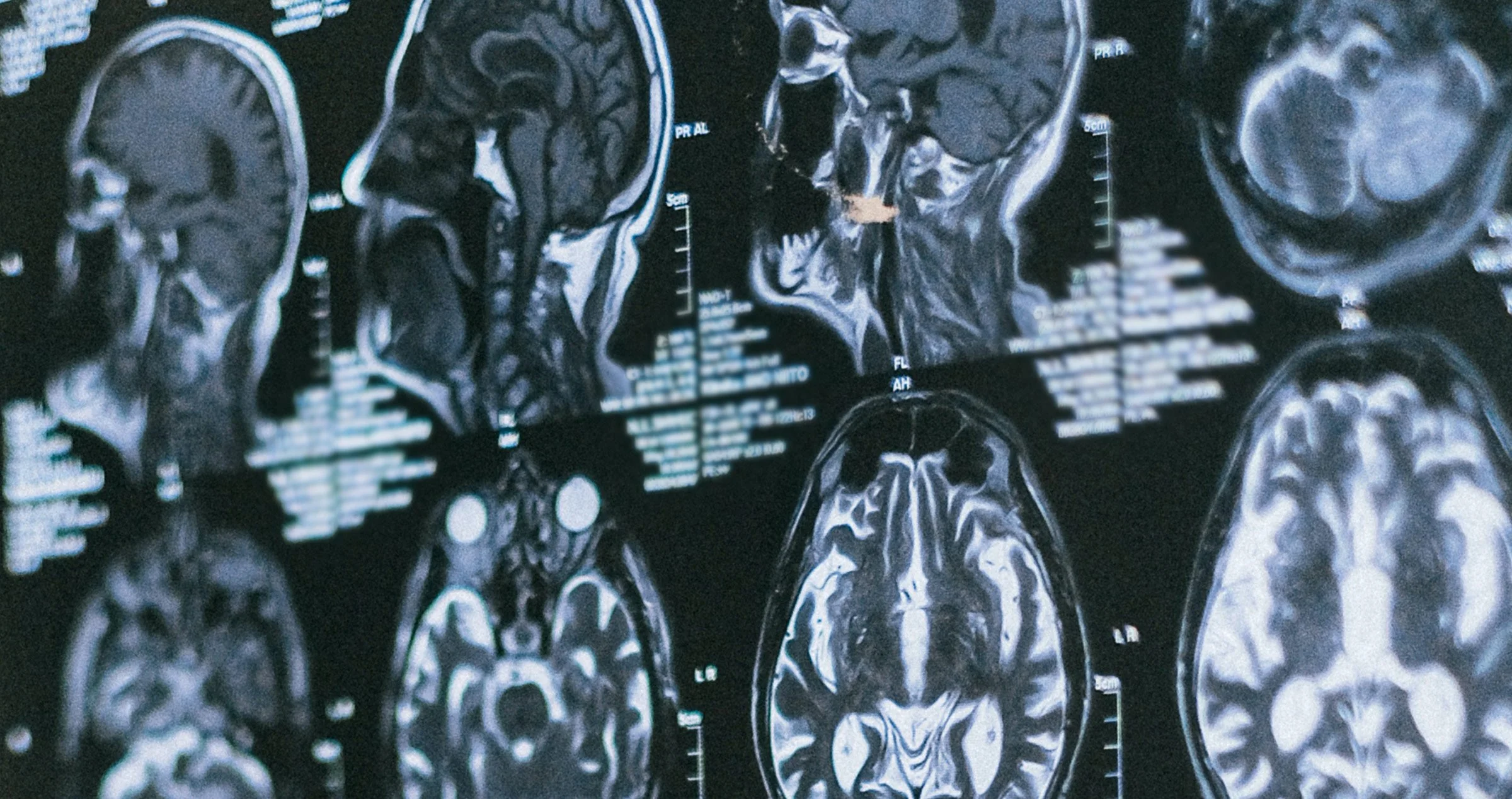 Blurred images of MRI scans of human brains in different cross-sectional views.