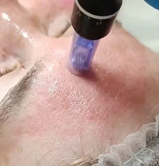 Close-up of a person's nose undergoing a skincare treatment with a blue device emitting light.