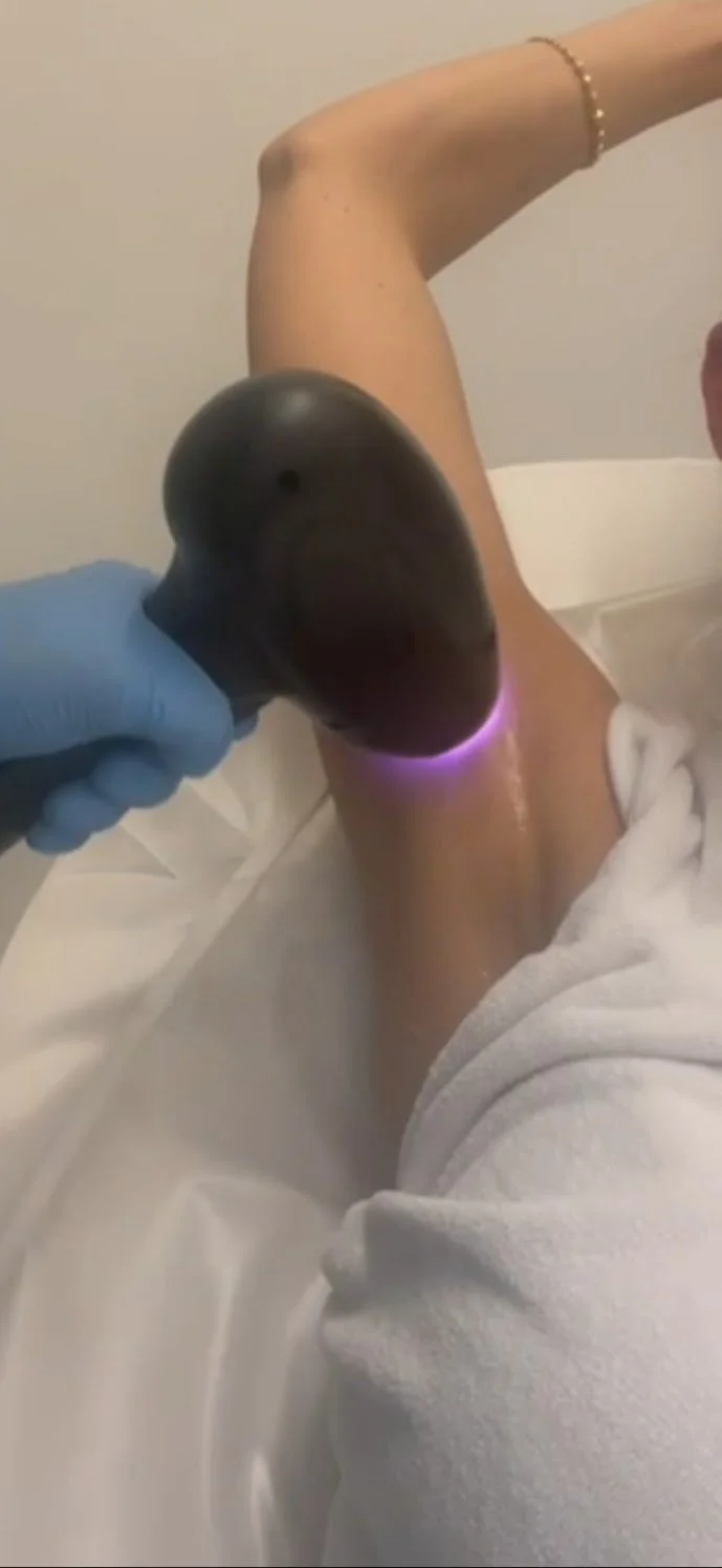Close-up of a person's underarm during a laser hair removal procedure, with a medical professional wearing a blue glove holding a laser device.
