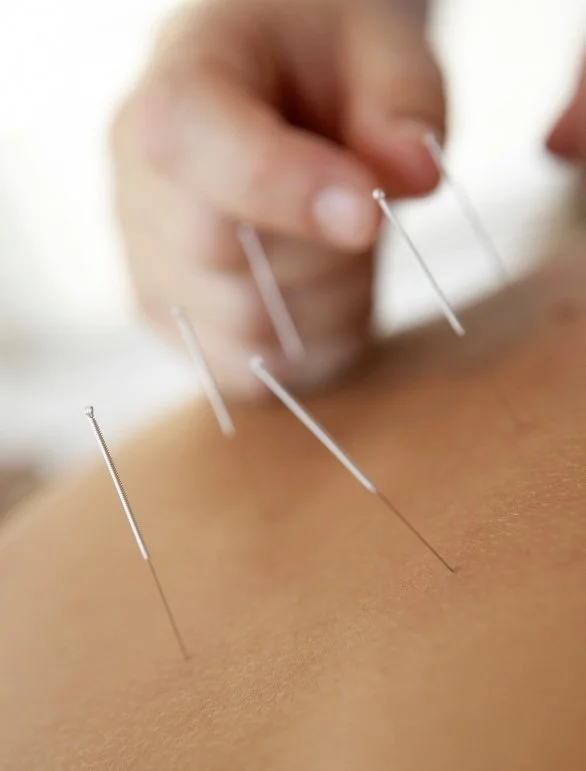 Close-up of acupuncture needles inserted into a person's skin during acupuncture treatment.