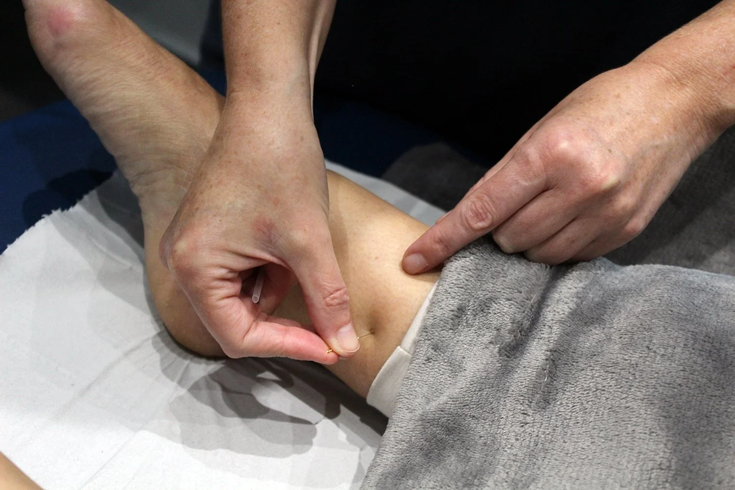 Close-up of a medical professional's hand in a blue glove using acupuncture needles on a person's skin.