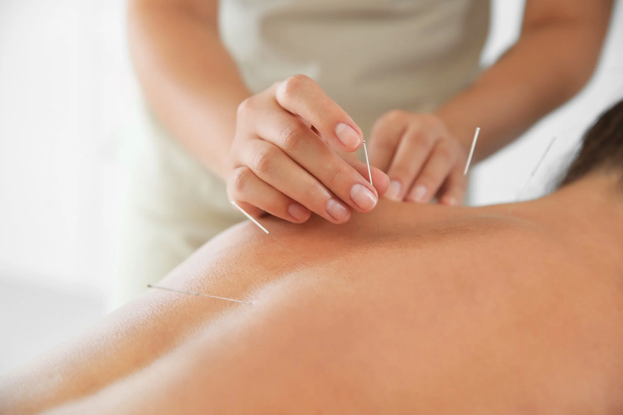 Acupuncture for pain management in Newcastle – a natural path to lasting relief
