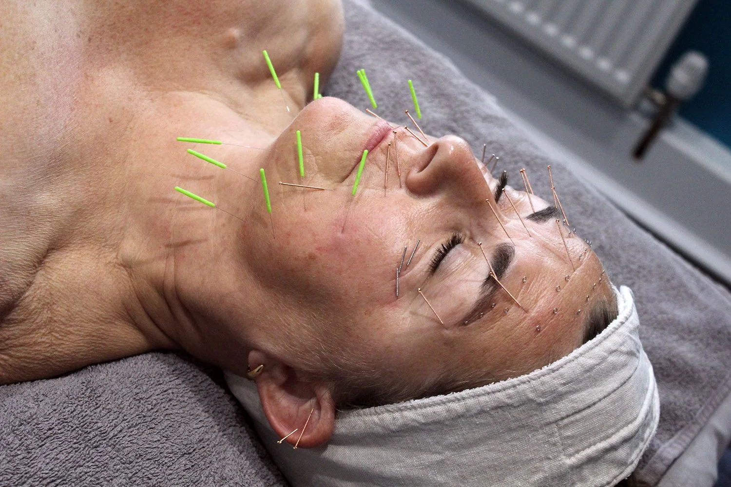 A woman receiving facial acupuncture treatment with numerous thin needles inserted into her face, lying on a treatment table with her eyes closed.