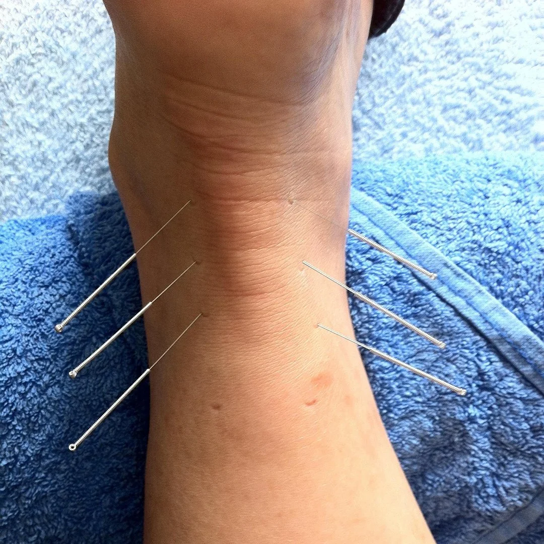 A person's ankle with acupuncture needles inserted, resting on a blue towel.