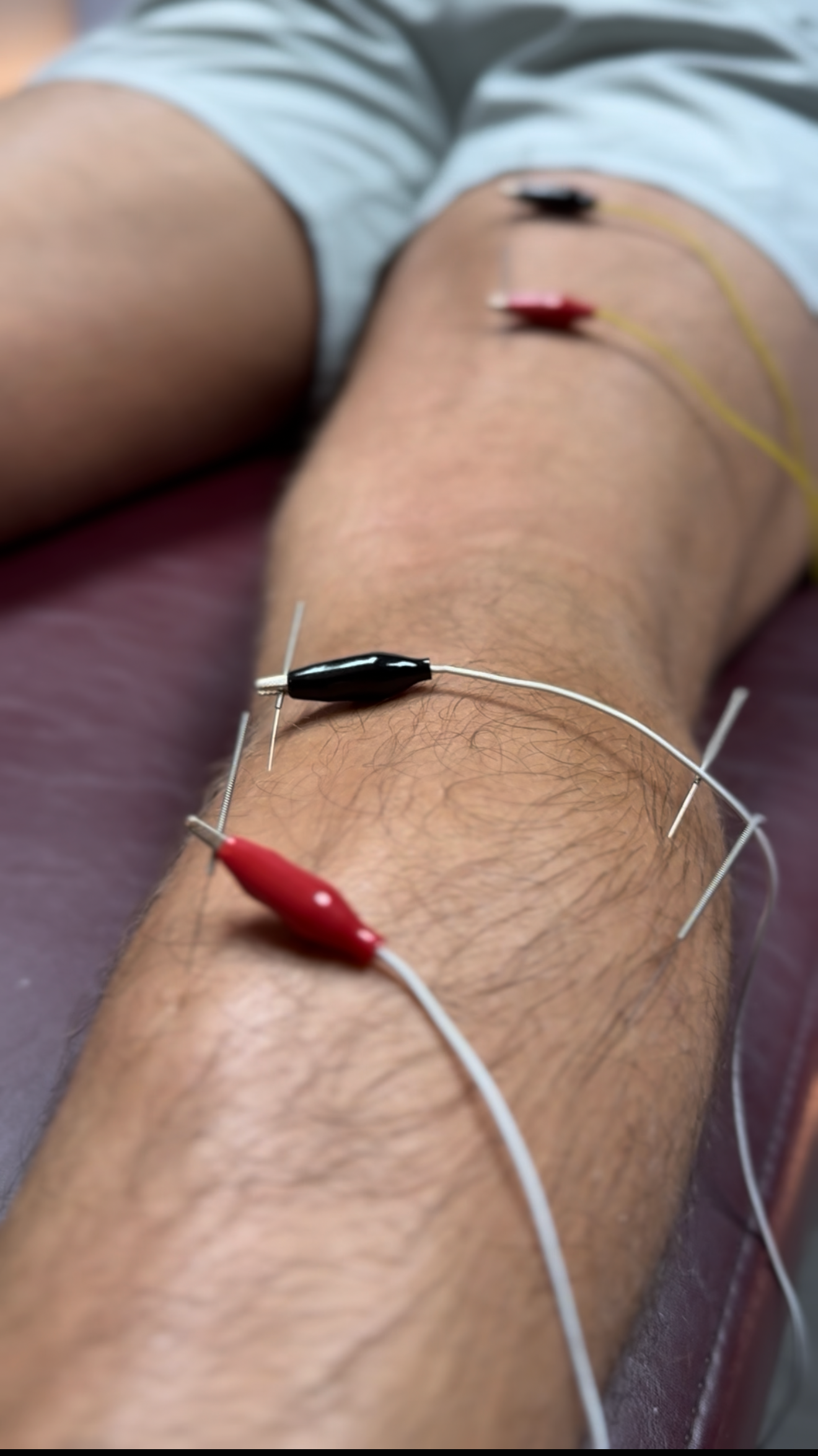 Dry needling therapy and stem used on the body