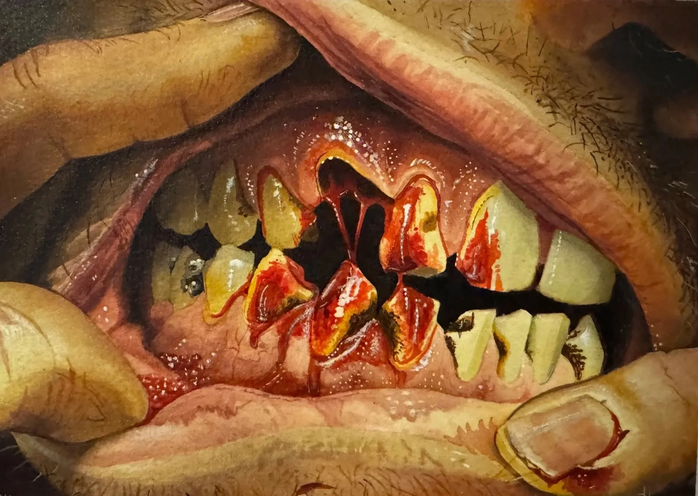 A close-up view of a person's mouth being held open by their fingers, revealing rotten teeth covered in blood and decay.
